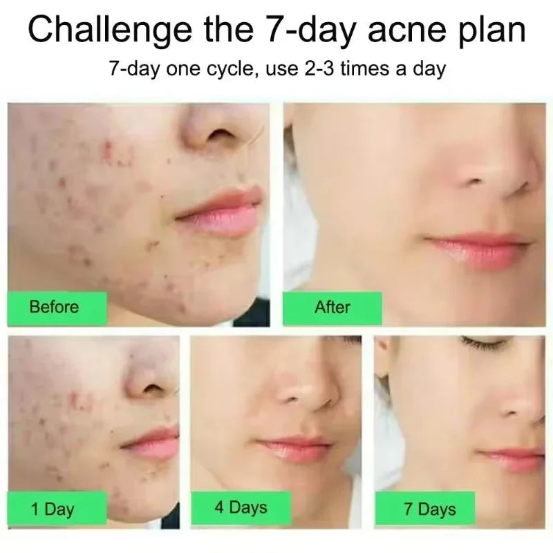 PWYUMAN Salicylic Acid Anti-Acne Cream – Deep Pore Cleansing & Blemish Treatment Ointment