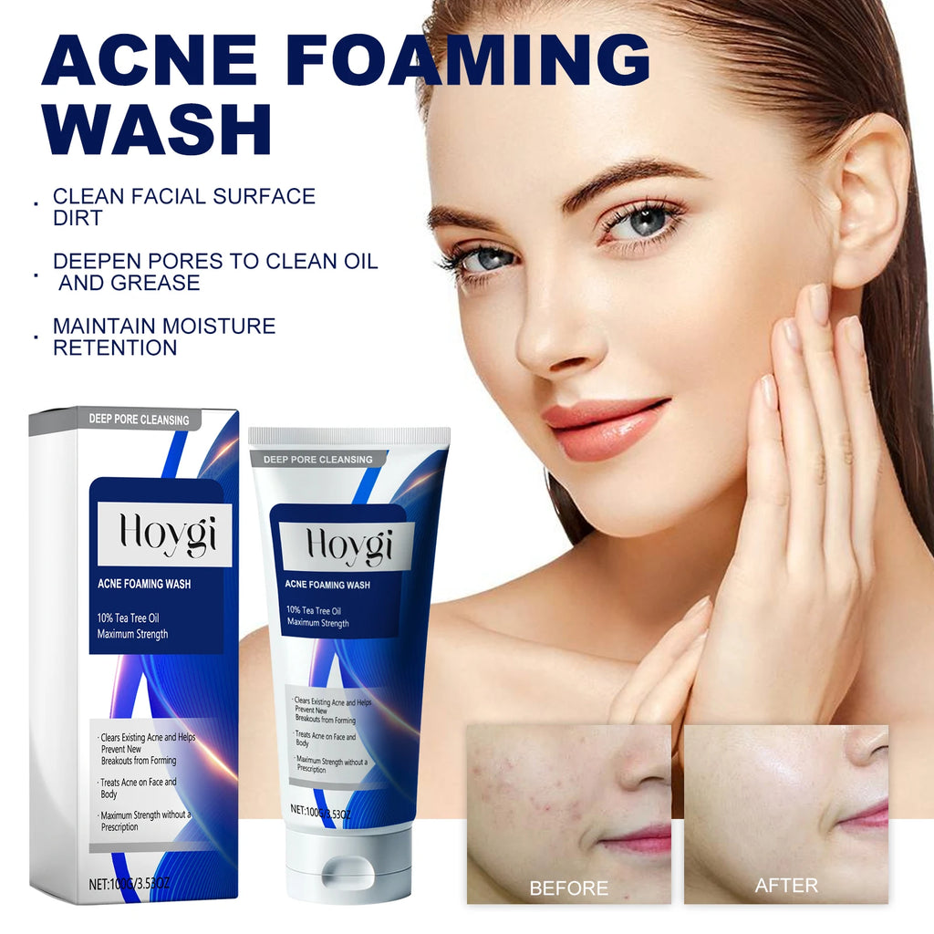 Hoygi Acne Foaming Wash – 10% Tea Tree Oil Deep Pore Cleanser