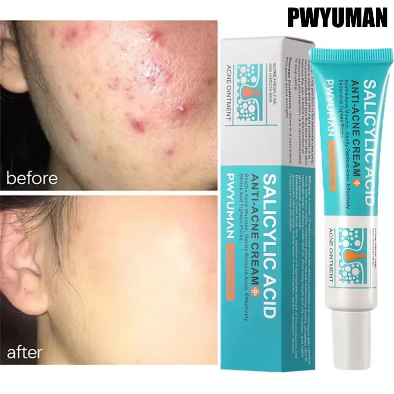 PWYUMAN Salicylic Acid Anti-Acne Cream – Deep Pore Cleansing & Blemish Treatment Ointment