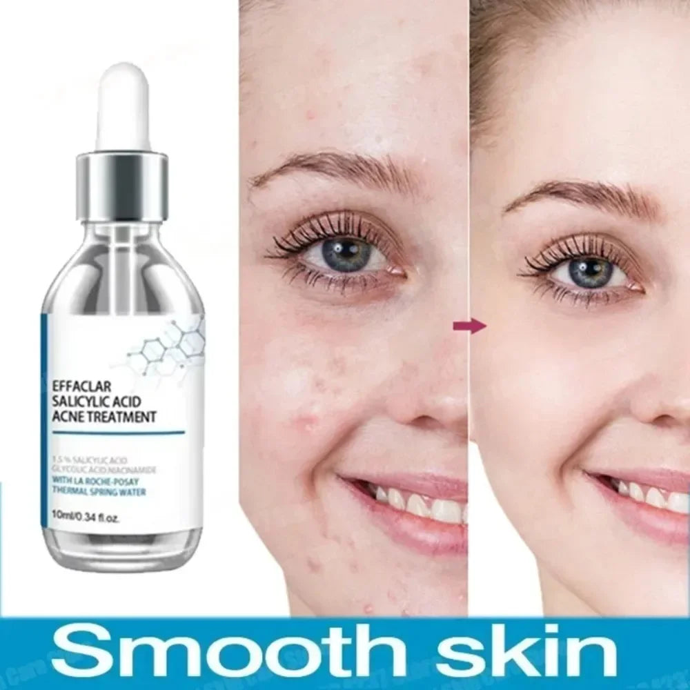 Salicylic Acid Clarifying Serum – Acne Clearing, Blemish & Pore Minimizing Essence with Niacinamide & Glycolic Acid