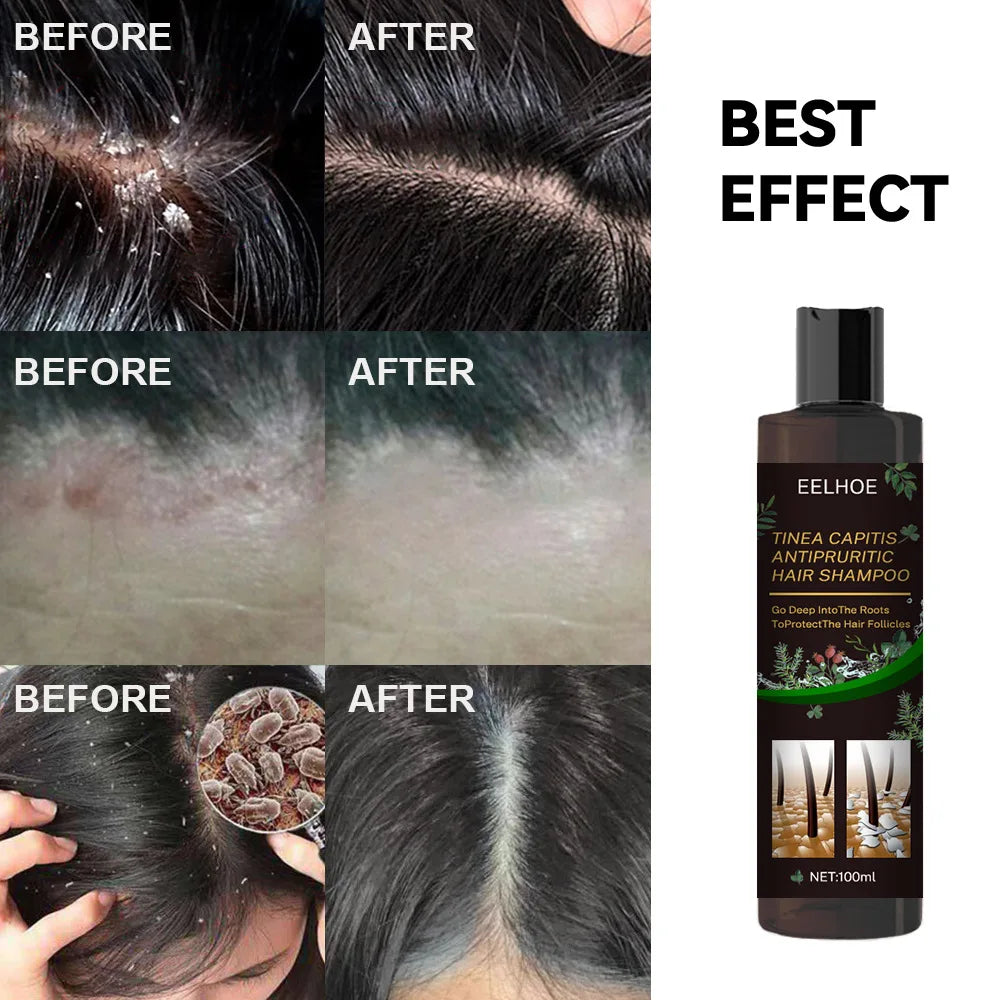 EELHOE Anti-Dandruff & Itch Relief Scalp Shampoo (100ml) – Deep Follicle Cleanser for Flaking, Scalp Ringworm & Follicle Care