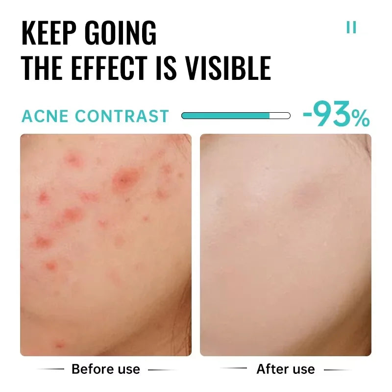 PWYUMAN Salicylic Acid Anti-Acne Cream – Deep Pore Cleansing & Blemish Treatment Ointment
