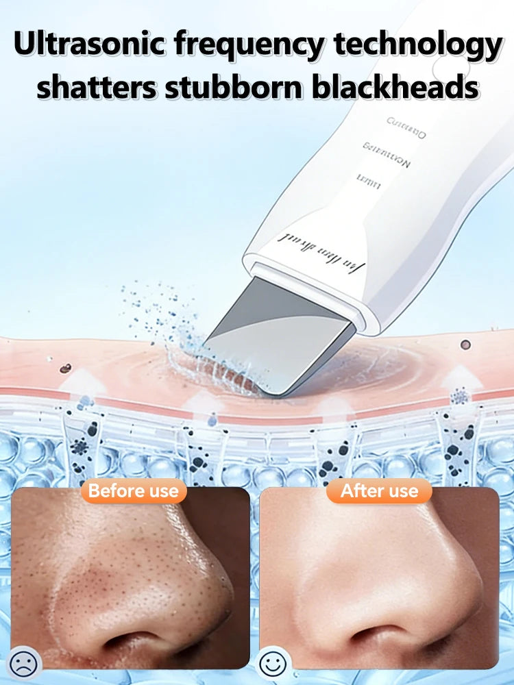 Ultrasonic Skin Scrubber – Pore Cleanser, Blackhead Remover & Facial Lifting Spatula