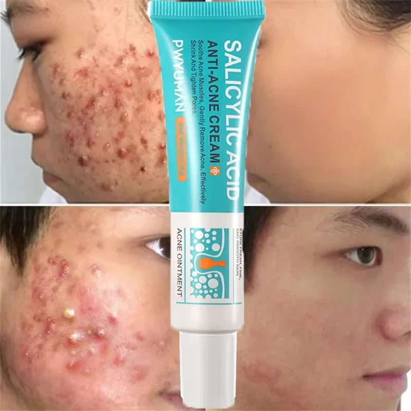 PWYUMAN Salicylic Acid Anti-Acne Cream – Deep Pore Cleansing & Blemish Treatment Ointment